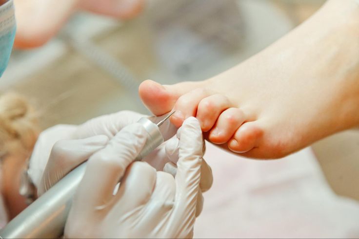 Medische pedicure behandeling